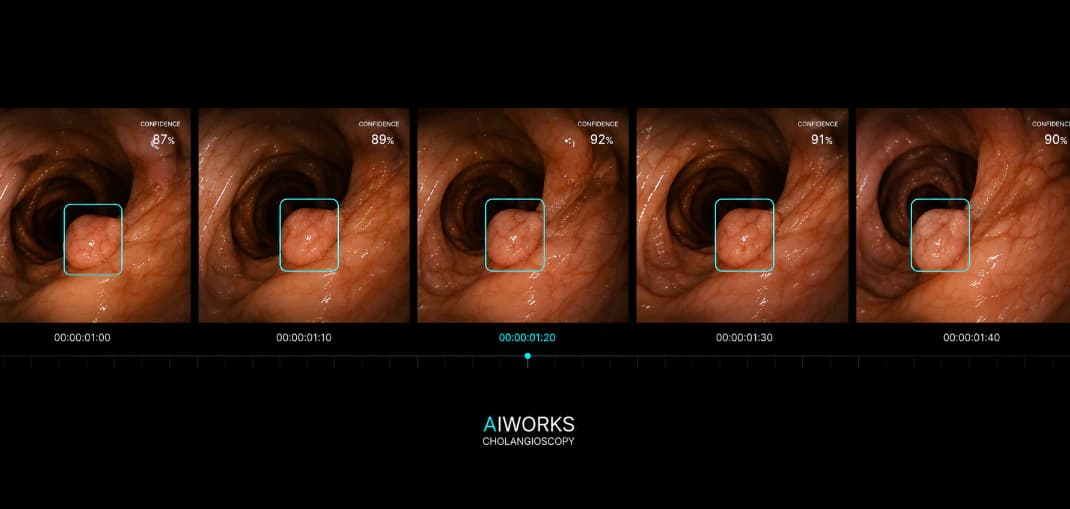 Endoscopic video sequence with detections and confidence levels