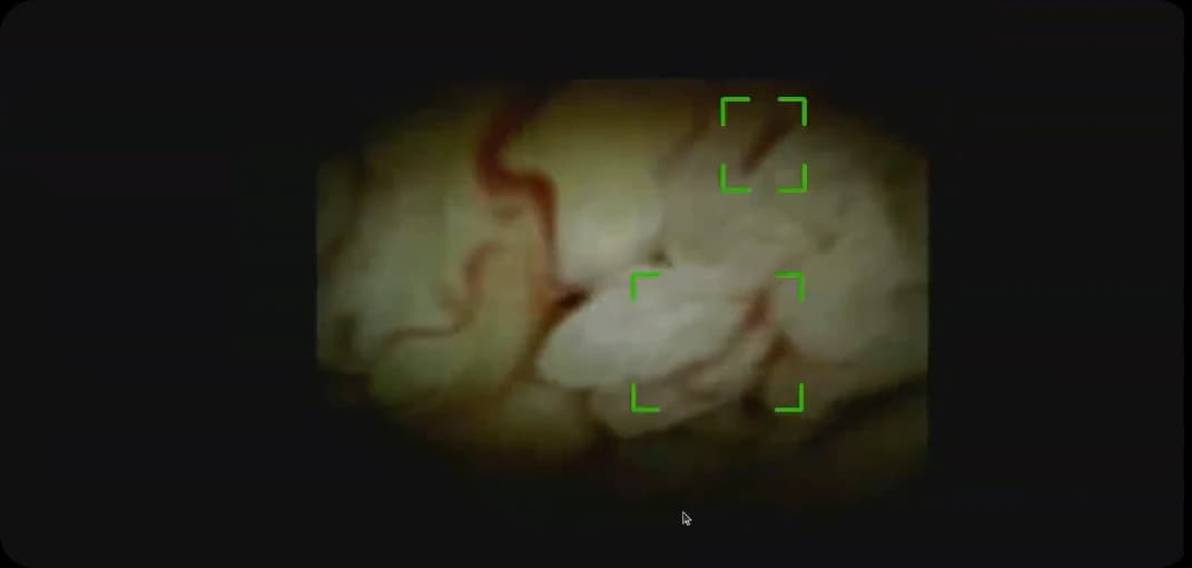 Areas of interest highlighted in a cholangioscopy image